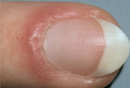 Đoán bệnh qua móng tay: Có thể đoán được bệnh của bạn thông qua móng tay. Điều này đã nhận được sự chú ý lớn từ bác sĩ và nhà nghiên cứu tại Việt Nam vào năm