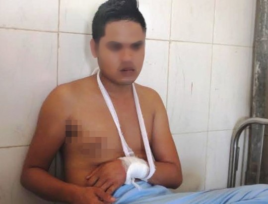 
Anh Nguyễn Đăng Hùng (con bà Vân) bị chém đứt gân tay, đứt động mạch và các dây thần kinh ngoại biên đang được điều trị tại Bệnh viên Đa khoa huyện Thạch Thành
