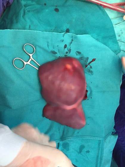 Tại một phòng mổ khác khối gan hỏng của bệnh nhân đã được PGS Nguyễn Tiến Quyết cắt bỏ để đưa lá gan mới vào cơ thể bệnh nhân T.N.H, 59 tuổi, ở Hà Nội