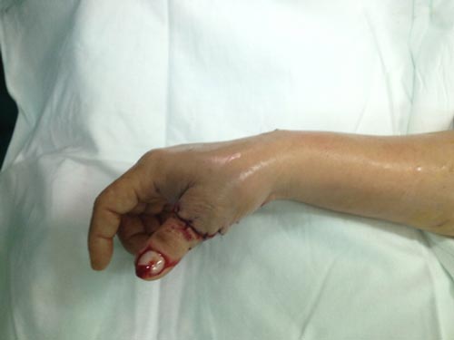 Một trường hợp bị kiếng cắt tay được các bác sĩ Bệnh viện Nhân dân 115 (TP HCM) phẫu thuật