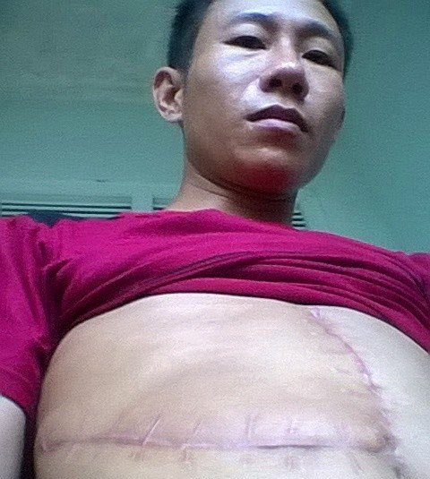 Anh Phan Doanh vẫn còn bàng hoàng khi nhắc đến việc suýt mất mạng vì bị trâu húc thủng phổi, vỡ gan.