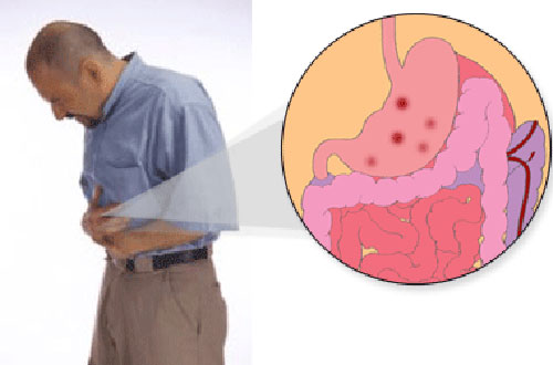 
Bệnh nhân thường đau vùng bụng trên ở giữa hoặc bên trái, có khi lan ra sau lưng. Ảnh: SGIHEALTH

