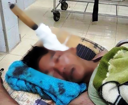 
Anh Trần Văn Ngân bị đồng nghiệp đâm thẳng dao vào đầu khiến con dao găm sâu vào đầu nạn nhân
