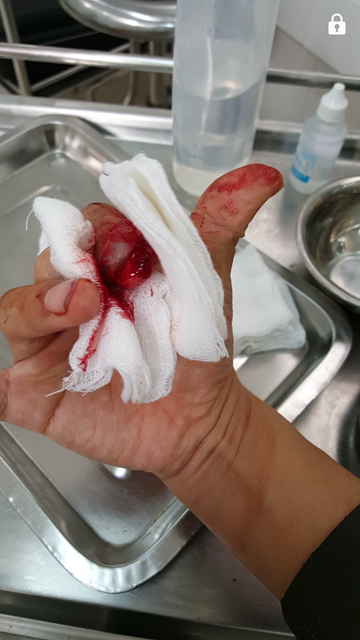 
Bàn tay của nhà báo Đỗ Doãn Hoàng bị thương tích nặng nhất - Ảnh: Lao động
