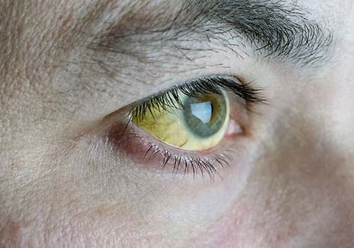 Vàng da và mắt ở người trưởng thành thường là dấu hiệu bệnh lý Ảnh: MNT