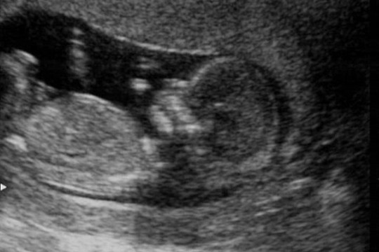 Chinese woman considers 8-month abortion to save husband’s job