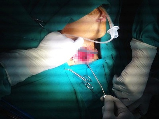 
Bệnh nhi Nguyễn Viết Đ. lúc được các bác sĩ Bệnh viện Nhi Thanh Hóa tiến hành phẫu thuật, cấp cứu. Ảnh bệnh viện cung cấp

