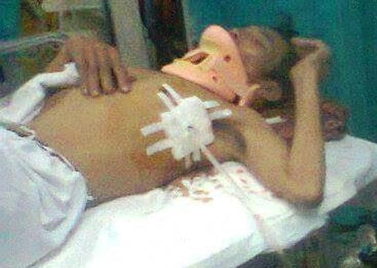 Ông Vũ Văn Điều bị đánh gãy xương sườn lúc đang cấp cứu tại Bệnh viện Việt Đức (ảnh gia đình cung cấp)