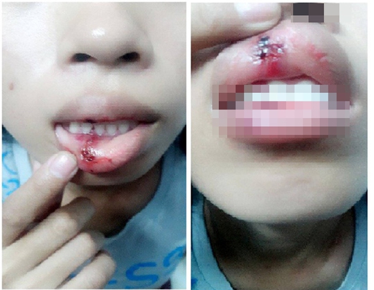 
Cô gái bị đánh dập môi, chảy máu khi tranh cãi với CSGT (ảnh do nhân vật trong clip cung cấp)
