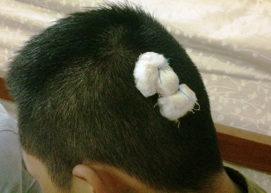Vết thương trên đầu Nguyễn Minh Quân được khâu tại Trạm y tế xã Thành Vân
