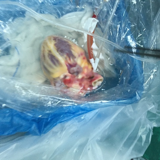 Quả tim sau khi phẫu thuật lập tức được bảo quản trong dung dịch đặc biệt và cho một túi nilon sau đo bỏ vào thùng đá