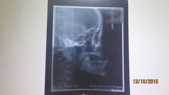 
Hàm trên chị T. bị tụt và 2 cm so với hàm dưới sau va đập tai nạn (Xóa tên trên phim X-quang)
