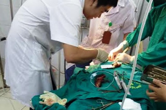 
Con cá rô khá to (chỗ khoanh tròn) được các bác sĩ phẫu thuật gắp ra từ cổ họng của ông Lê Văn H.
