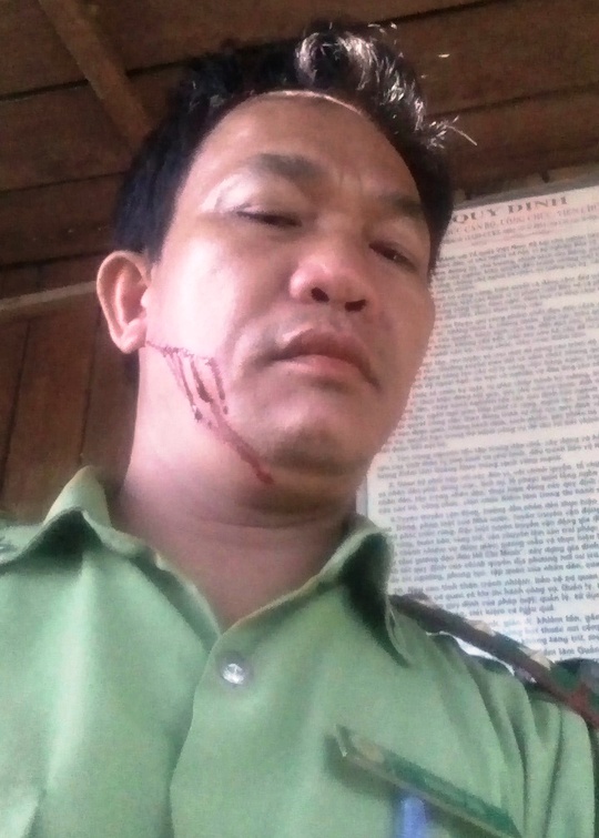 
Kiểm lâm viên Nguyễn Thà bị aalm tặc chém Ảnh: CTV
