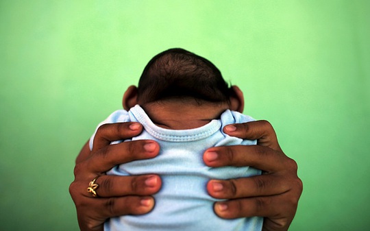 Một đứa trẻ bị hội chứng đầu nhỏ ở TP Olinda - Brazil. Ảnh: Reuters