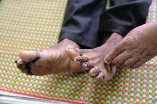 Bàn chân của bệnh nhân Đinh Văn Nguyên cũng bị nổi mẫn đỏ, thâm tím. Ảnh: Tử Trực