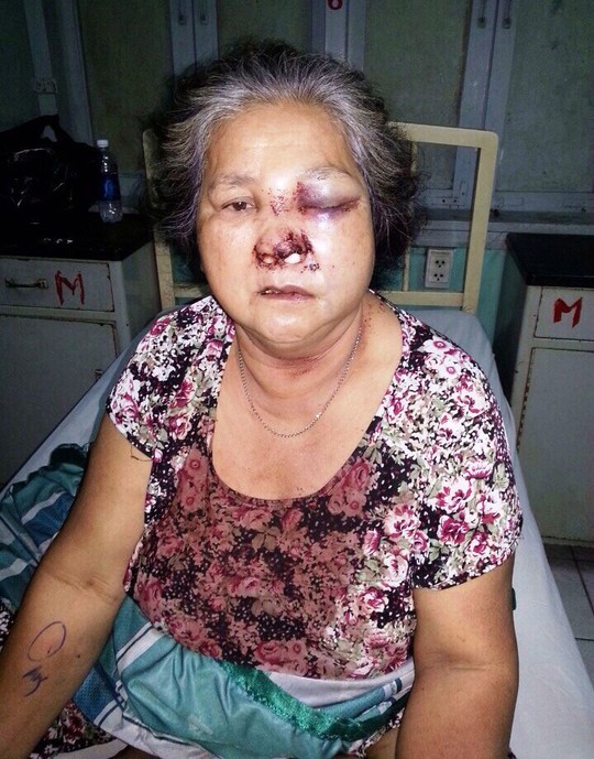 Bà Lê Thị Hoàng bị thương tích 34%