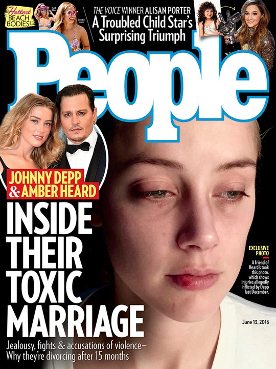 Amber tố rằng đây là vết thương do bị Johnny Depp bạo hành