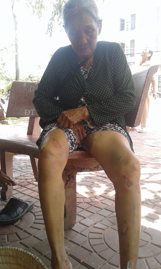 Bà cụ bị đa chấn thương ở chân do bị kẻ cướp kéo gã