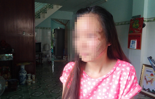 Vũ Thị Hà bị tạt axít vào tháng 10-2015. Hiện Hà đã bỏ học, sống trong những chuỗi ngày đau đớn và tự ti
