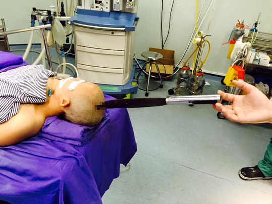 
Thai phụ được đưa đến bệnh viện với con dao nhọn cắm sâu 4 cm vào đỉnh đầu
