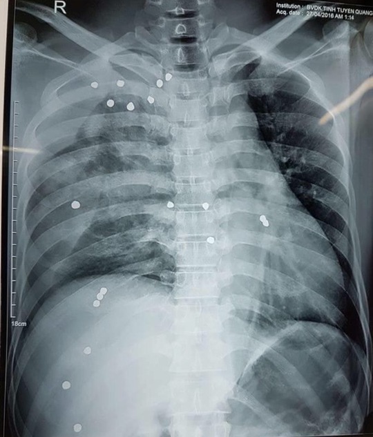 
Hình ảnh phim X-quang của bệnh nhân với hàng chục viên đạn găm trong người
