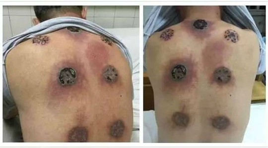 
Những vết thương kinh dị trên lưng ông Li Lin. Ảnh: China Times/Weibo
