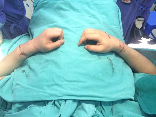 
Hai cẳng tay nạn nhân N.M.T. được 2 kíp phẫu thuật Bệnh viện Việt Đức ghép nối đang hồi phục tốt - Ảnh do bác sĩ cung cấp
