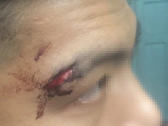 
Đặng Văn Q. (20 tuổi, quận Tân Bình) bị tét mí mắt sau khi rời trụ sở công an phường Bến Thành ngày 10-5
