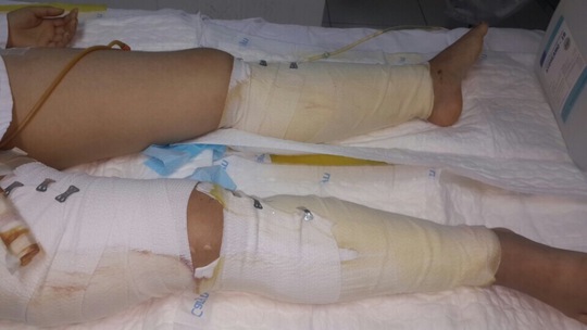 
Dù bị chấn thương nhưng đôi chân của cô gái 18 tuổi trong vụ sập nhà phố Cửa Bắc đang phục hồi

 

