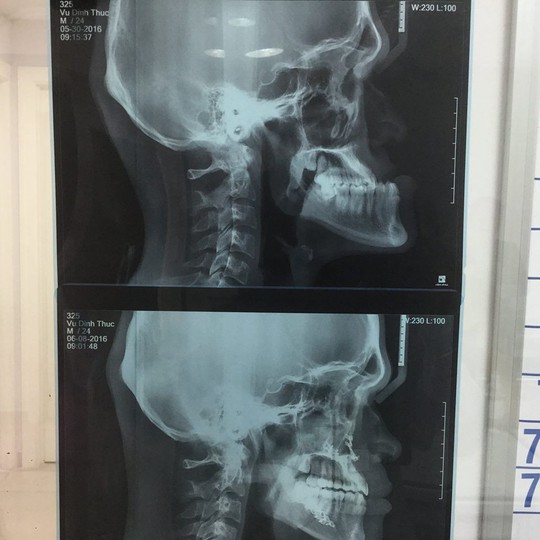 Hình ảnh 3D xương hàm sọ trước và sau phẫu thuật