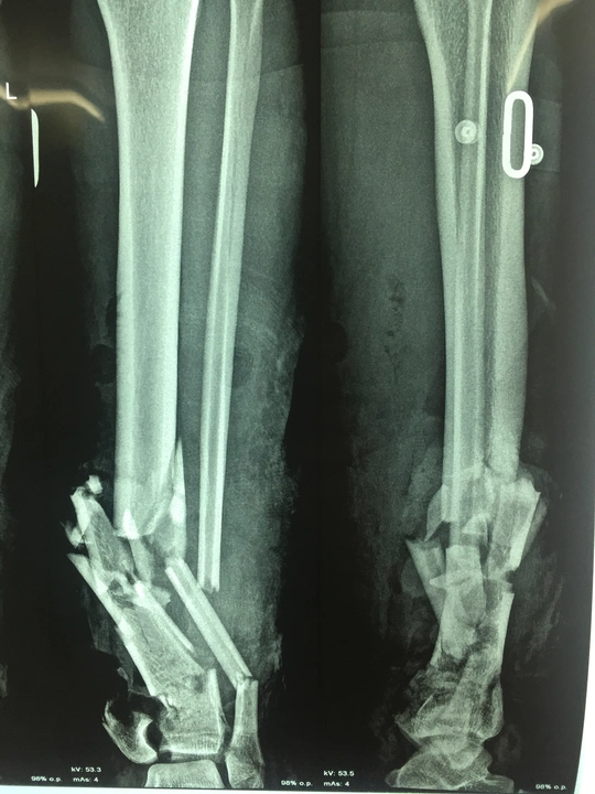 
Phim X-quang cho thấy xương bệnh nhân đã vỡ nát - ẢNH DO BỆNH VIỆN CUNG CẤP
