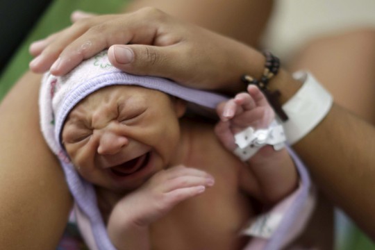 Một bé gái 7 ngày tuổi ở Brazil bị đầu nhỏ, rối loạn thần kinh gây tổn thương não và ảnh hưởng thị giác - các triệu chứng bị nghi do virus Zika gây raẢnh: REUTERS