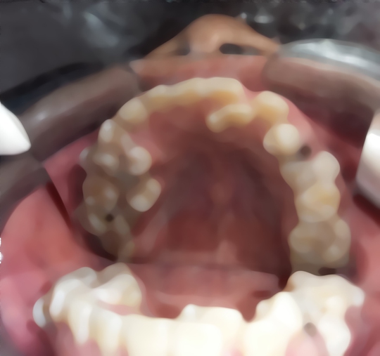 
Việc thừa tới 13 chiếc rằng đã dẫn tới việc bệnh nhân Đ.V.S. bị viêm tủy răng
