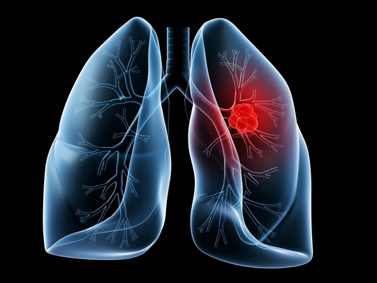 
Ung thư phổi chiếm tỷ lệ tử vong cao nhất trong số các loại ung thư.
