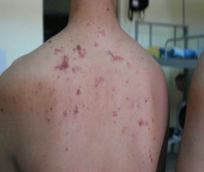 
Trên lưng đầy những vết thương do kiến ba khoang để lại
