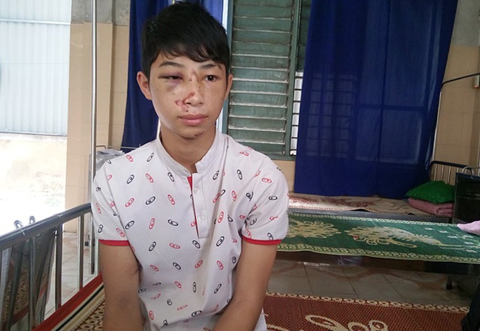 
Em Nguyễn Đức Phú bị hành hung đến thâm tím mặt mũi
