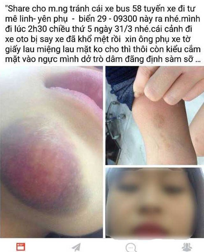 Nữ sinh Q.A tố bị phụ xe buýt đánh thâm tím cằm - ảnh: Facebook