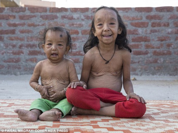 Ấn Độ: Hai chị em ruột cùng bị lão hóa