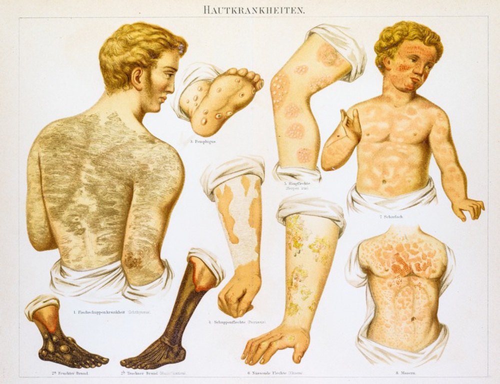 Bóng ma bệnh sởi: Từ cổ văn Ba Tư đến "thần chết" Thái Bình Dương- Ảnh 5.