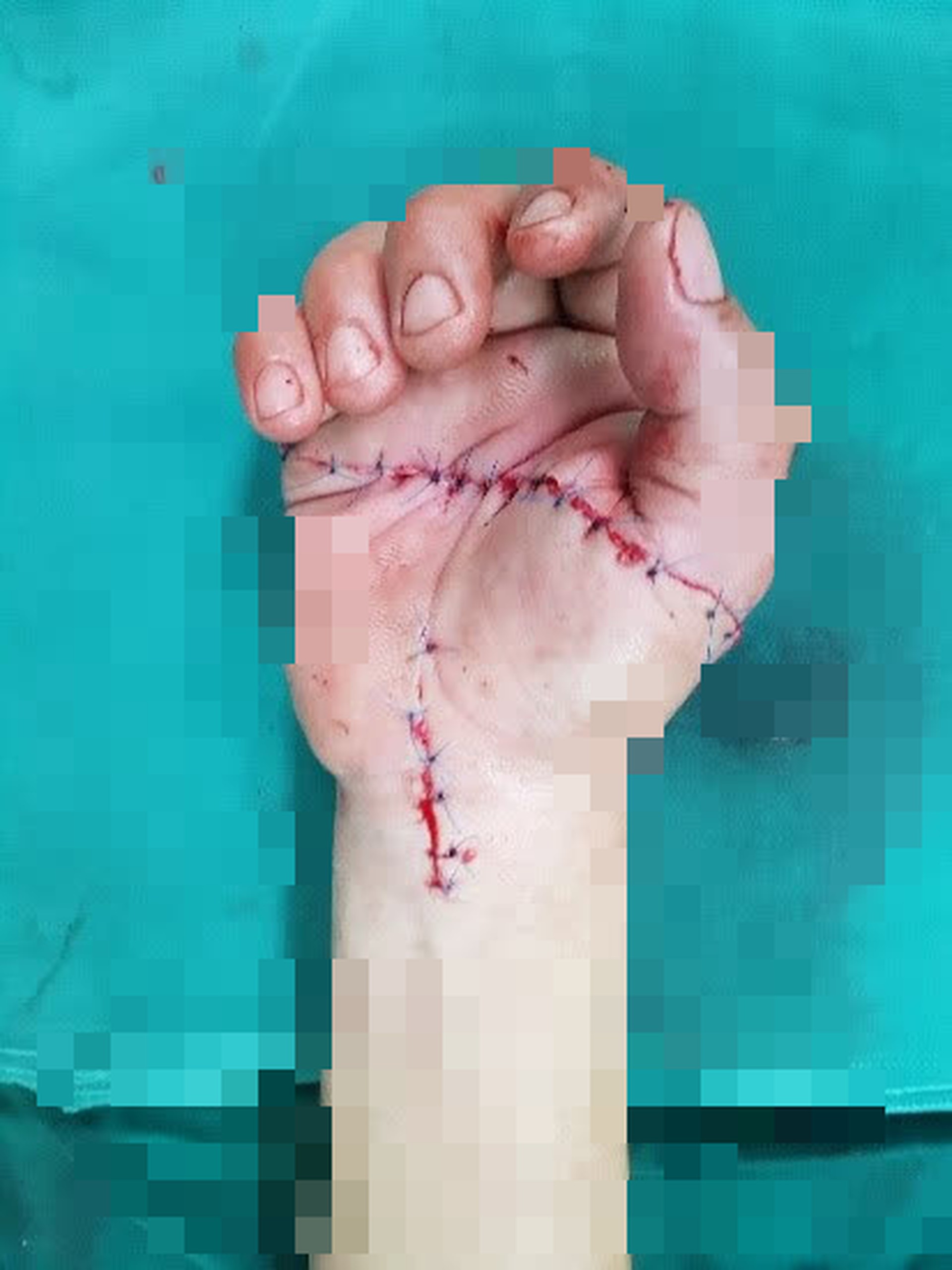 Vừa trở lại l&agrave;m việc sau gi&atilde;n c&aacute;ch, người đ&agrave;n &ocirc;ng bị cưa m&aacute;y ch&eacute;m đứt gần l&igrave;a b&agrave;n tay - Ảnh 2.