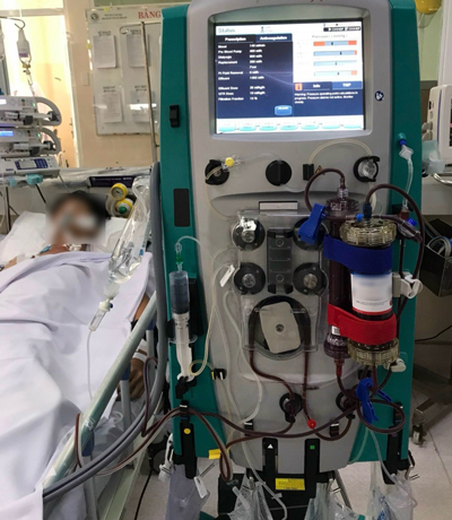 Một bệnh nh&acirc;n ngộ độc h&oacute;a chất được lọc m&aacute;u tại Bệnh viện L&ecirc; Văn Thịnh (TP Thủ Đức, TP HCM)
