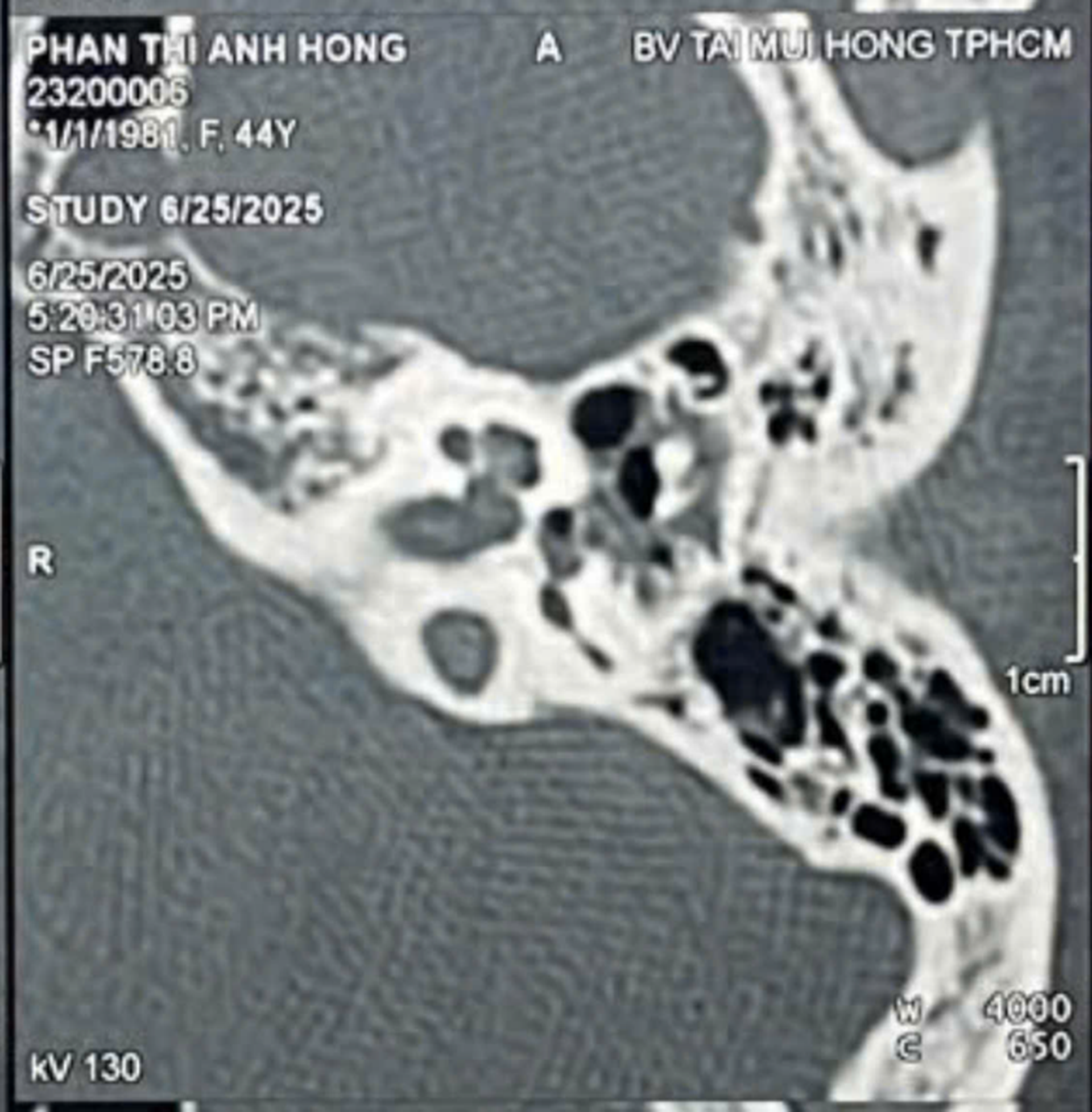 Một phụ nữ r&aacute;ch m&agrave;ng nhĩ do ngo&aacute;y tai - Ảnh 2.