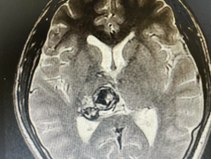 Nam sinh viên 20 tuổi phát hiện khối u não sau khi thấy đau đầu, chóng mặt