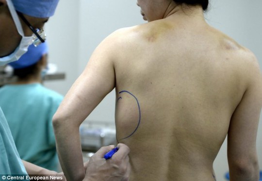 Một phần ngực cấy ghép di chuyển xuống lưng cô Hui. Ảnh: Central European News