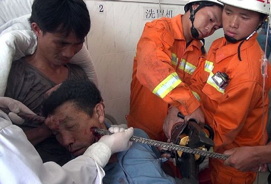 Bị thanh sắt xuyên từ trán xuống hàm vẫn sống sót kỳ diệu