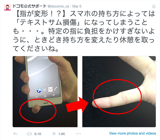 Ngón tay út bị biến dạng nếu dùng smartphone quá nhiều?