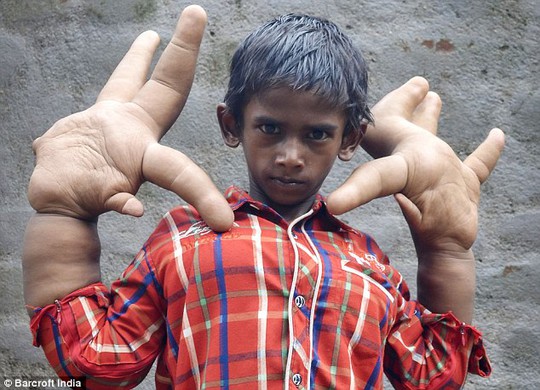 Bàn tay khổng lồ của cậu bé Ấn Độ