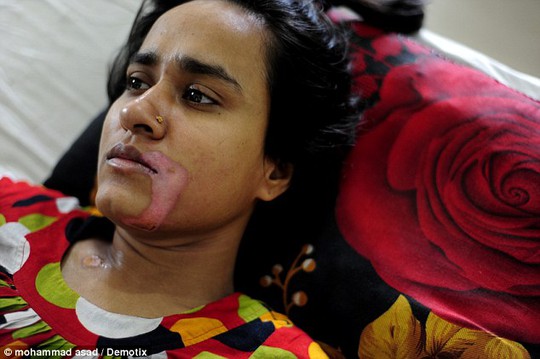 Cô Ripa Rani Pandit mang vết sẹo vĩnh viễn trên khuôn mặt và những tổn thương nội tạng nghiêm trọng. Ảnh: Demotix