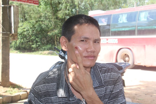 Anh Trần Văn Tuấn (chủ xe) bị nhóm côn đồ hành hung khiến chấn thương ở mặt
